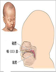 腭裂手术之前,出现腭裂语音的原因,主要是发音器官